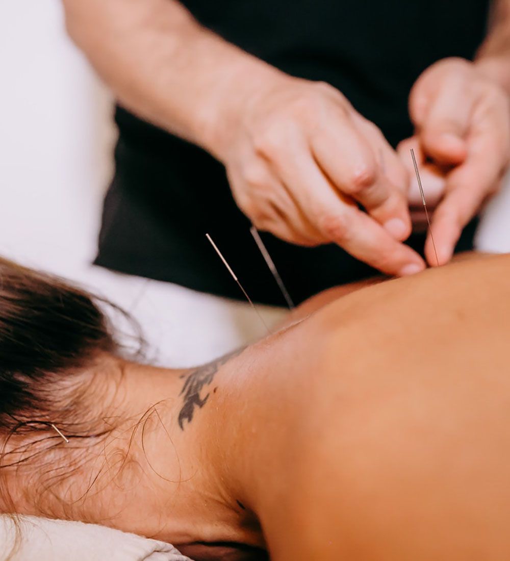 Acupuncture