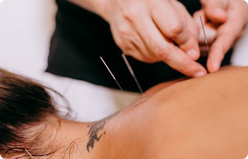 Acupuncture treatment being performed on a patient's back